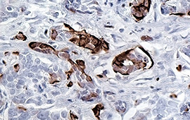 Breast Cancer: CK6 — Anti-Rabbit HRP (3)